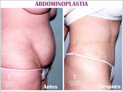Abdominoplastia